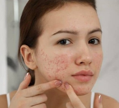 سابسیژن جای جوش 1میلیون تومان (با بن کارت هدیه 600 هزار تومان)
