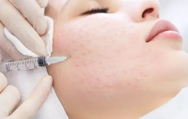 مزوتراپی صورت هر سی سی 1میلیون تومان( با بن کارت هدیه 800 هزارتومان)