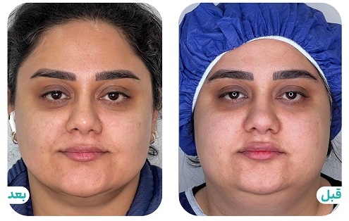 ساکشن غبغب در تبریز؛ دستیابی به خط فک ایده‌آل با دکتر صابر