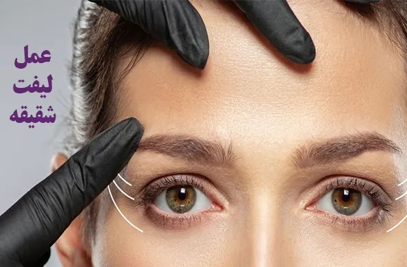 لیفت شقیقه در تبریز؛ راهکاری قطعی برای داشتن چشمانی کشیده و زیبا