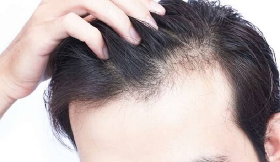 آزمایشهای ویژه ریزش مو (مردان)