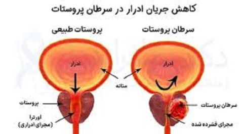 سرطان پروستات