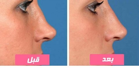 تزریق آنزیم بینی در تبریز