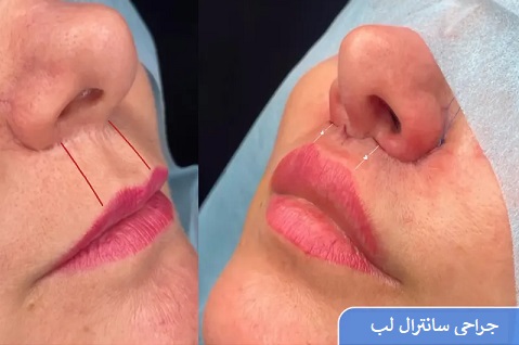 بهترین پزشکان متخصص سانترال لب در تبریز