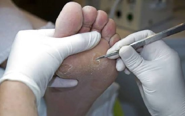 خدمات برداشتن پینه و میخچه در تبریز