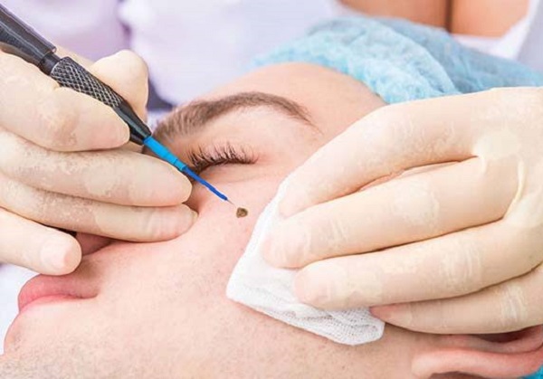 خدمات برداشتن خال و زگیل در تبریز