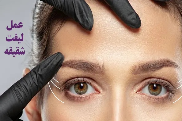 خدمات جراحی لیفت شقیقه در تبریز